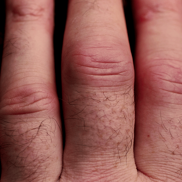 Rheumatoid Arthritis Fingers-by david__jones